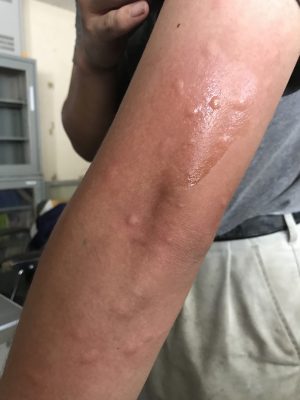 大量の虫刺され